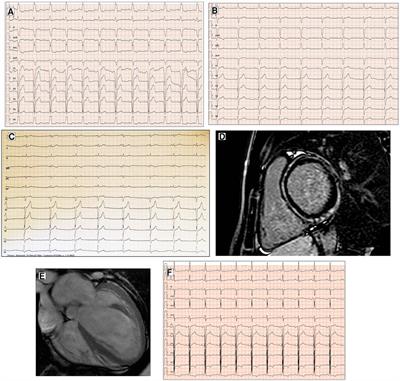 The pivotal role of ECG in cardiomyopathies